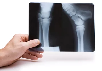 Bonejoint 6