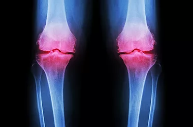 Knee oa